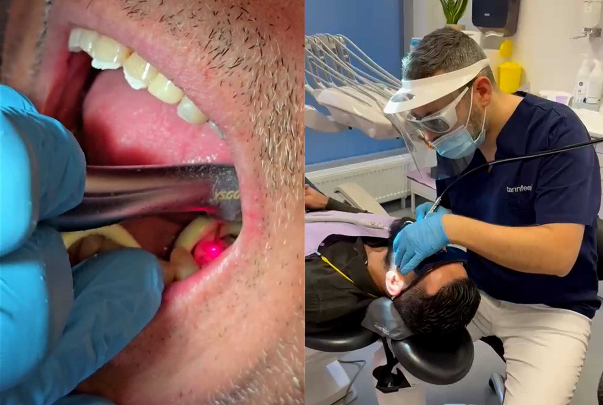 WaterLase Tannbehandling med laser Tannfeen i Sarpsborg