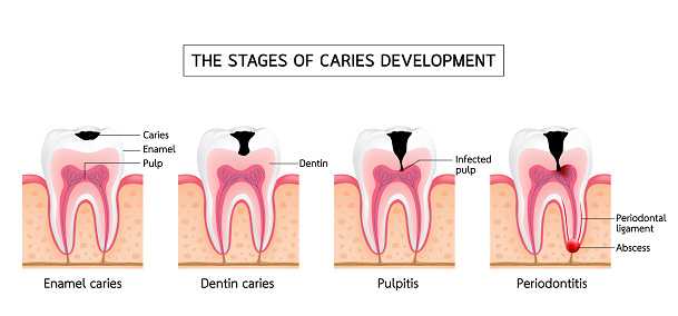 utvikling fra gingivitt til periodontitt